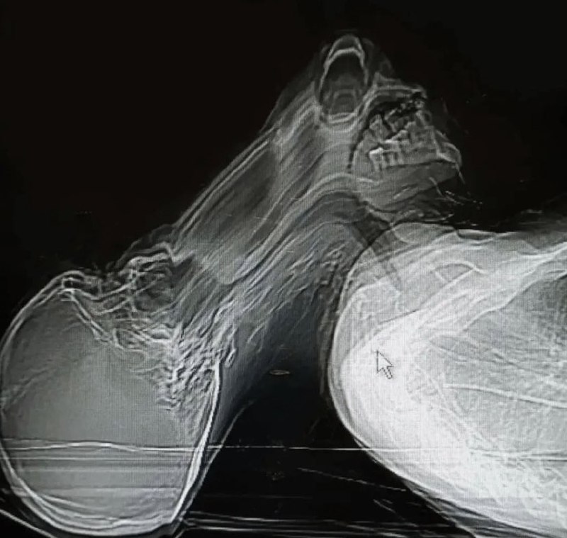 Sam Ghali, M.D. (@EM_RESUS)