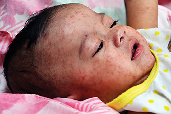 Measles outbreak in Texas grows to 48 cases; pediatricians working to vaccinate children