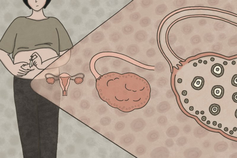 【圖解新聞】解開卵子的祕密：女人一生會排多少卵？捐卵、凍卵怎麼做？風險大嗎？ - 報導者 The Reporter