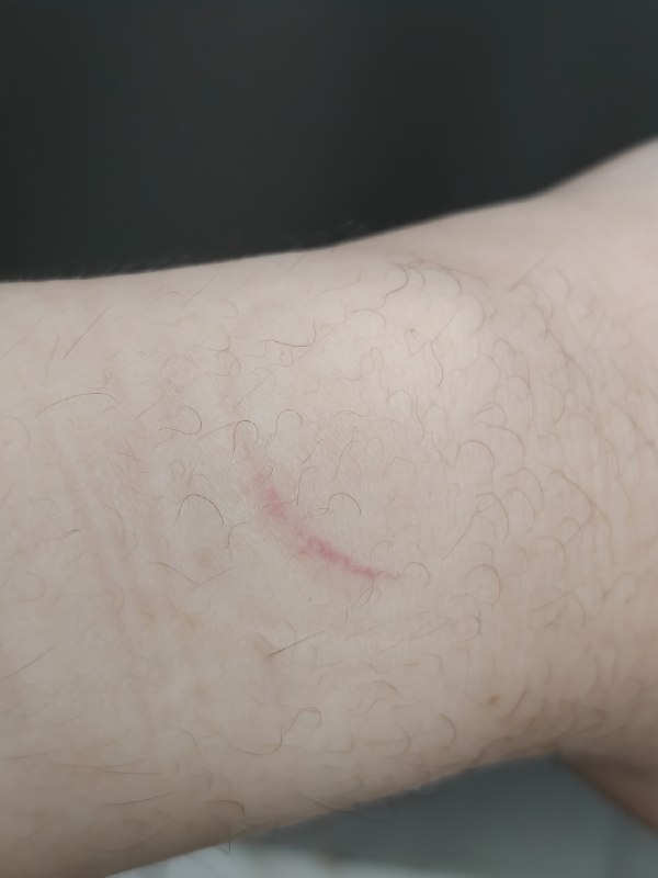 只有戴苹果表的时候手腕会伤得这么厉害我的手腕是可以戴最小的那个孔的，过去这半年都多放一格戴得松一点，至少一周一次用中性洗手液（含保湿成分）清洁手表和手腕以前觉得我是 #bug体质 和苹果的垃圾软件合不来，没想到现在连硬件都不兼容了（照片上能看出来其实大多数时候手表都滑到腕骨的地方了，真的没法再松了）