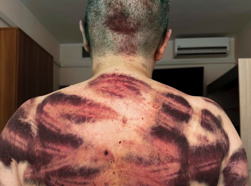 【俄國記者車臣遇襲，遭毒打威脅，所有手指骨折，曾堅持報導當地LGBT集中營】